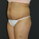 Liposuction Case 6856, Before Treatment, Female Patient, Thumbnail 4