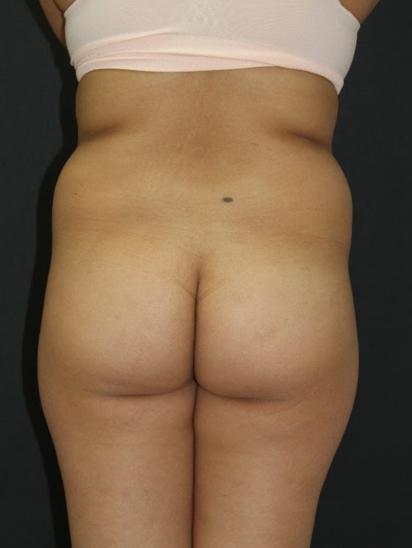 Liposuction Case 6856, Before Treatment, Female Patient, Set 8