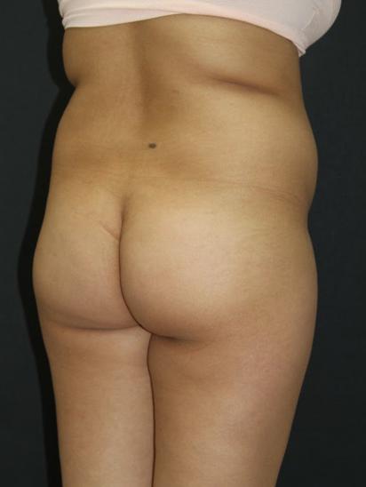 Liposuction Case 6856, Before Treatment, Female Patient, Set 7