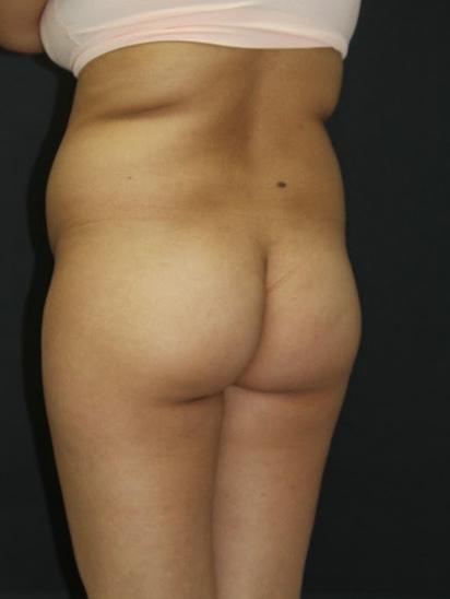 Liposuction Case 6856, Before Treatment, Female Patient, Set 6