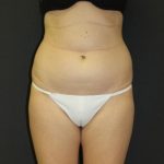 Liposuction Case 6857, Before Treatment, Female Patient, Thumbnail 1