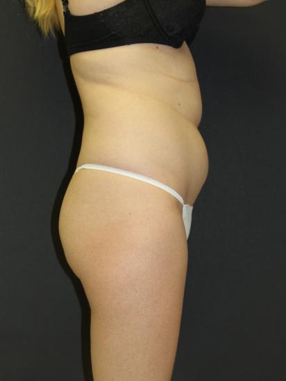 Liposuction Case 6857, Before Treatment, Female Patient, Set 5