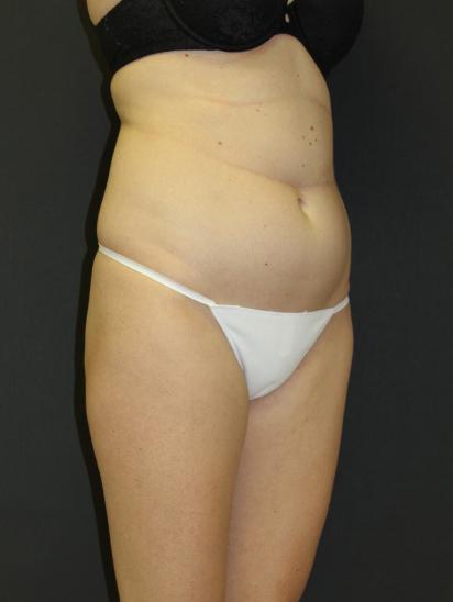 Liposuction Case 6857, Before Treatment, Female Patient, Set 4