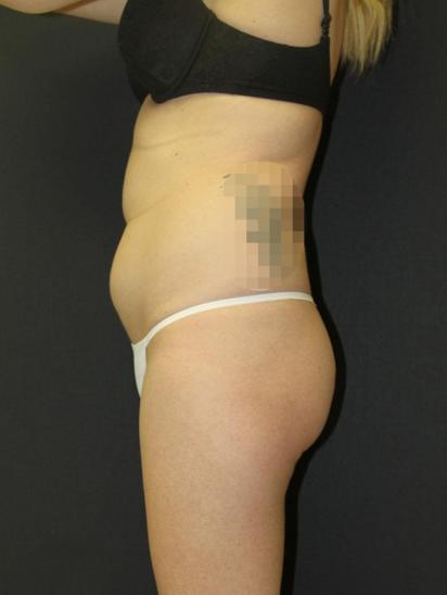 Liposuction Case 6857, Before Treatment, Female Patient, Set 3