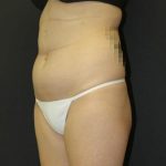 Liposuction Case 6857, Before Treatment, Female Patient, Thumbnail 2