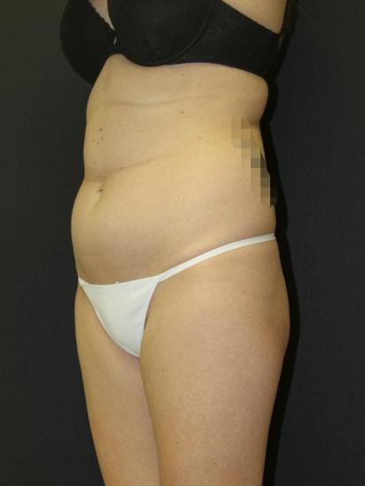 Liposuction Case 6857, Before Treatment, Female Patient, Set 2