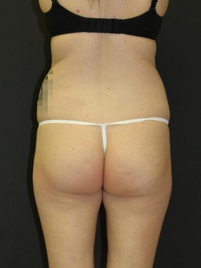Liposuction Case 6857, After Treatment, Female Patient, Set 6