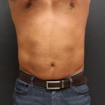 Liposuction Case 6858, After Treatment, Male Patient, Thumbnail 1