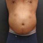 Liposuction Case 6858, Before Treatment, Male Patient, Thumbnail 1