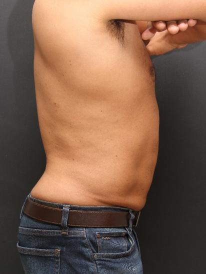 Liposuction Case 6858, After Treatment, Male Patient, Set 5