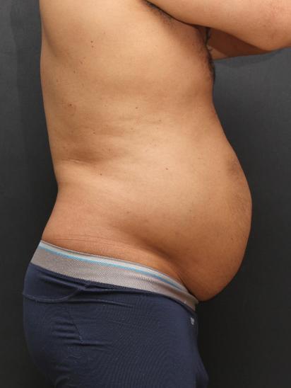Liposuction Case 6858, Before Treatment, Male Patient, Set 5
