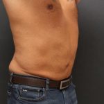Liposuction Case 6858, After Treatment, Male Patient, Thumbnail 4