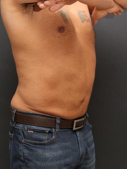 Liposuction Case 6858, After Treatment, Male Patient, Set 4