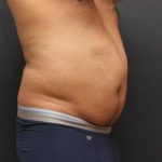 Liposuction Case 6858, Before Treatment, Male Patient, Thumbnail 4
