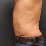 Liposuction Case 6858, After Treatment, Male Patient, Thumbnail 3