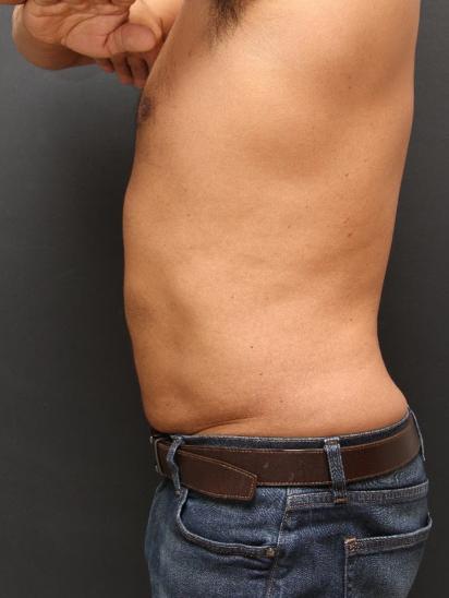 Liposuction Case 6858, After Treatment, Male Patient, Set 3