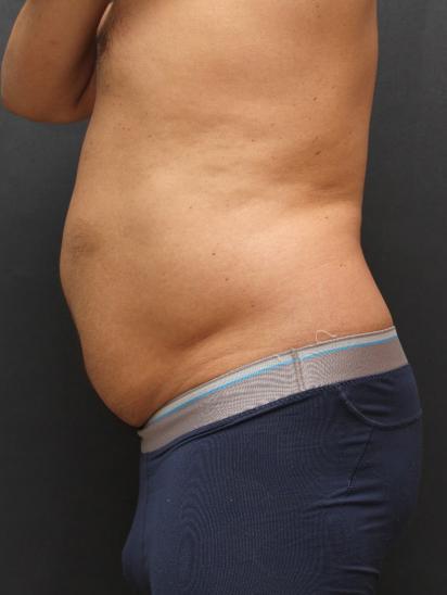 Liposuction Case 6858, Before Treatment, Male Patient, Set 3