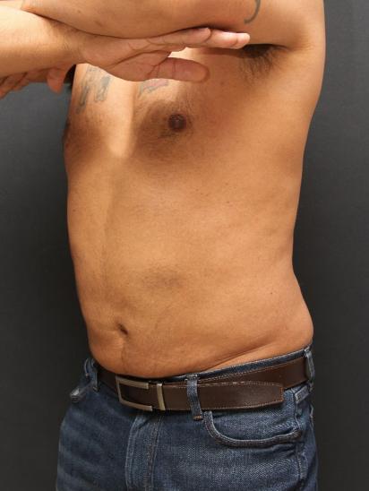 Liposuction Case 6858, After Treatment, Male Patient, Set 2