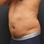 Liposuction Case 6858, Before Treatment, Male Patient, Thumbnail 2