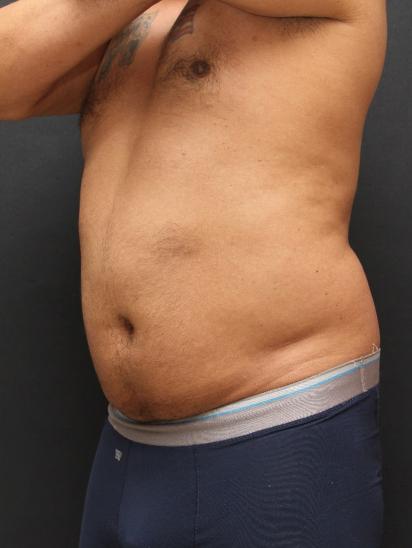 Liposuction Case 6858, Before Treatment, Male Patient, Set 2