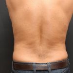 Liposuction Case 6858, After Treatment, Male Patient, Thumbnail 6