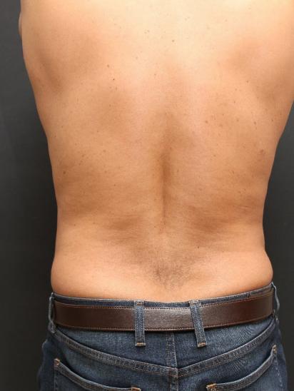 Liposuction Case 6858, After Treatment, Male Patient, Set 6