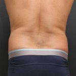Liposuction Case 6858, Before Treatment, Male Patient, Thumbnail 6