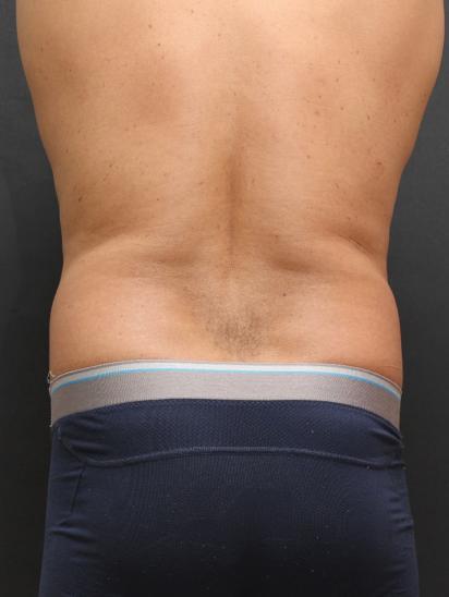 Liposuction Case 6858, Before Treatment, Male Patient, Set 6