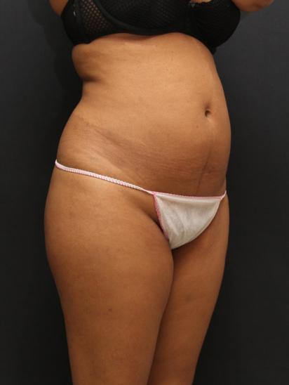 Liposuction Case 6859, Before Treatment, Female Patient, Set 2