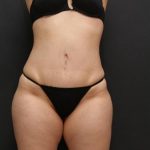 Liposuction Case 6860, After Treatment, Female Patient, Thumbnail 1