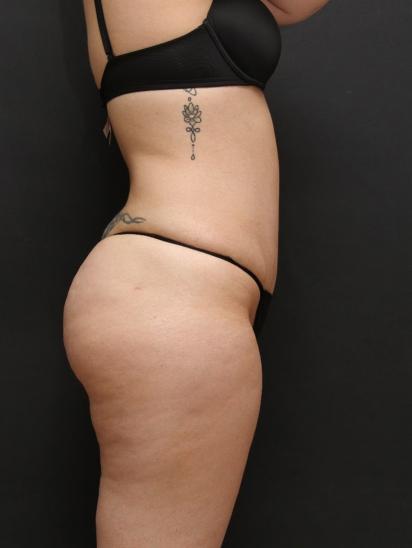 Liposuction Case 6860, After Treatment, Female Patient, Set 3