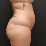 Liposuction Case 6860, Before Treatment, Female Patient, Thumbnail 3