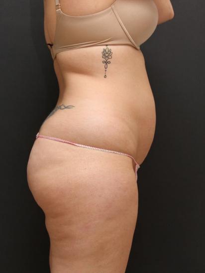 Liposuction Case 6860, Before Treatment, Female Patient, Set 3