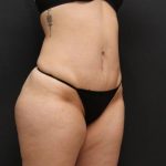Liposuction Case 6860, After Treatment, Female Patient, Thumbnail 2
