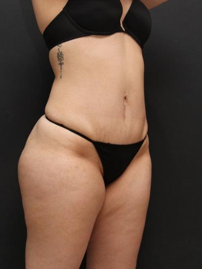 Liposuction Case 6860, After Treatment, Female Patient, Set 2