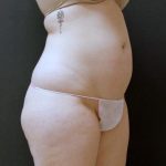 Liposuction Case 6860, Before Treatment, Female Patient, Thumbnail 2