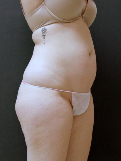 Liposuction Case 6860, Before Treatment, Female Patient, Set 2