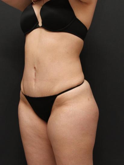 Liposuction Case 6860, After Treatment, Female Patient, Set 4