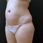 Liposuction Case 6860, Before Treatment, Female Patient, Thumbnail 4