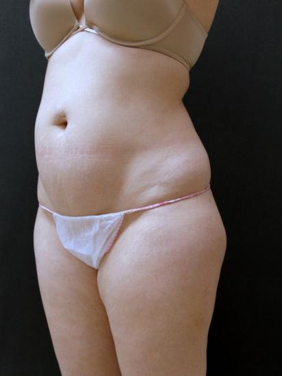 Liposuction Case 6860, Before Treatment, Female Patient, Set 4