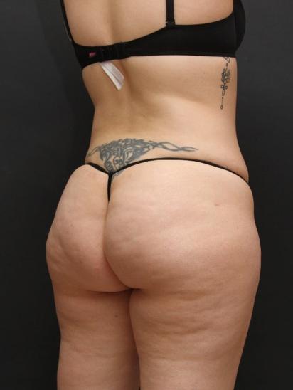 Liposuction Case 6860, After Treatment, Female Patient, Set 5