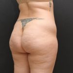 Liposuction Case 6860, Before Treatment, Female Patient, Thumbnail 5
