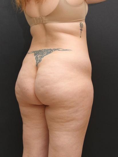 Liposuction Case 6860, Before Treatment, Female Patient, Set 5