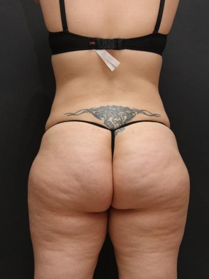 Liposuction Case 6860, After Treatment, Female Patient, Set 7