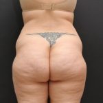 Liposuction Case 6860, Before Treatment, Female Patient, Thumbnail 7