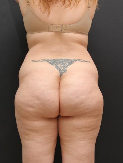 Liposuction Case 6860, Before Treatment, Female Patient, Set 7