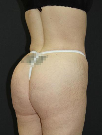 Liposuction Case 6860, After Treatment, Female Patient, Set 8