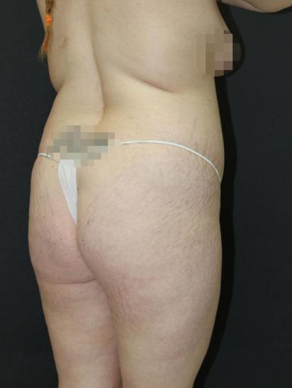 Liposuction Case 6860, Before Treatment, Female Patient, Set 8