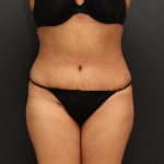 Liposuction Case 6862, After Treatment, Female Patient, Thumbnail 1