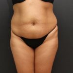 Liposuction Case 6862, Before Treatment, Female Patient, Thumbnail 1